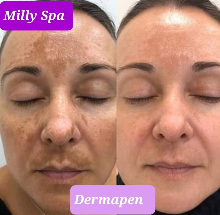 Limpieza facial Milly Spa: resultados visibles